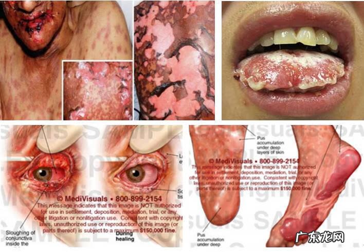 儿童脸上长湿疹图片 儿童湿疹的症状图片