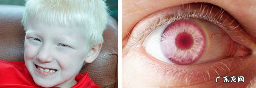 儿童脸上长湿疹图片 儿童湿疹的症状图片