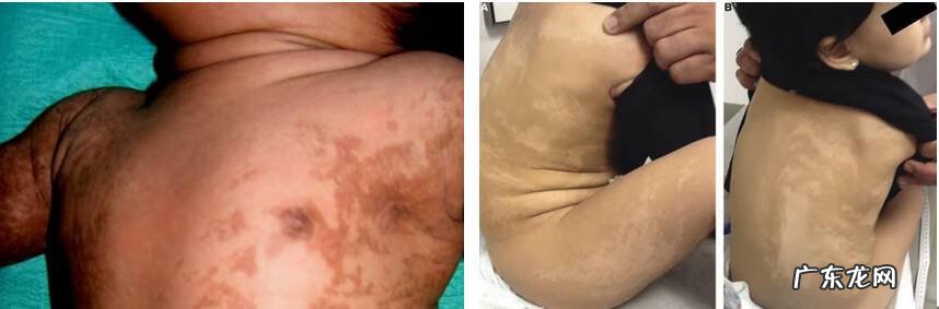 儿童脸上长湿疹图片 儿童湿疹的症状图片