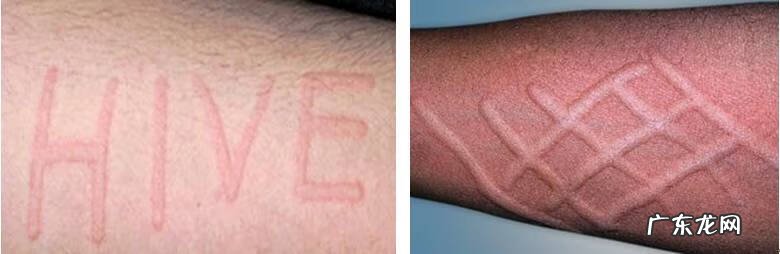 儿童脸上长湿疹图片 儿童湿疹的症状图片