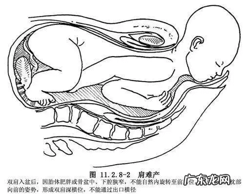 肩难产有成功生出来的吗 肩难产是什么意思