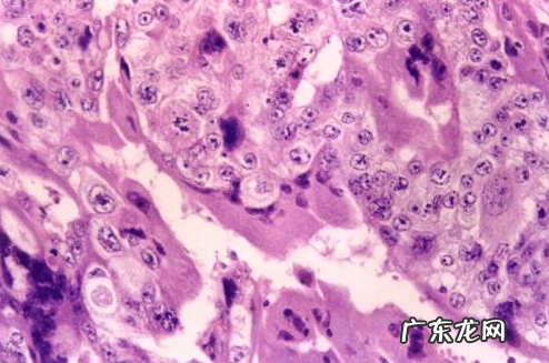 绒毛膜癌是什么意思 绒毛膜癌