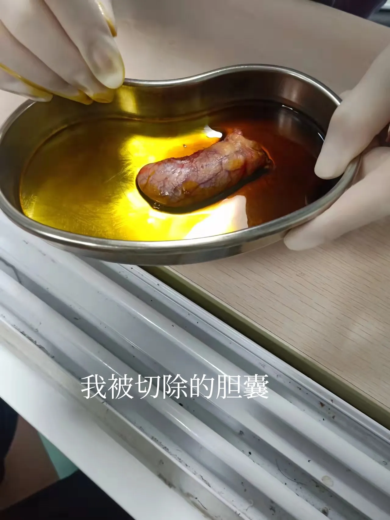 全身麻醉的真实感受是什么 麻醉过后伤口开始剧烈疼痛