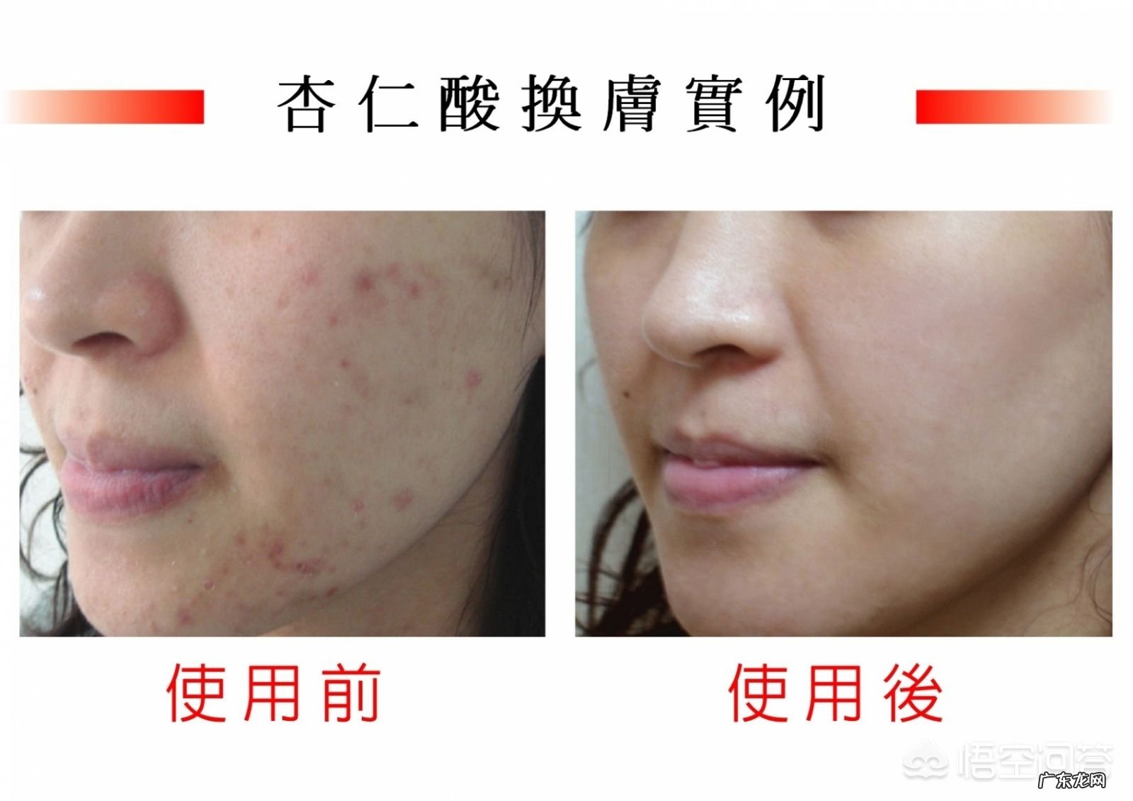 刷酸能祛痘和痘印还能美白,到底过程是怎样的?