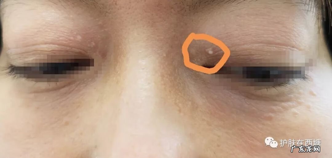 汗管瘤早期图片 汗管瘤图片