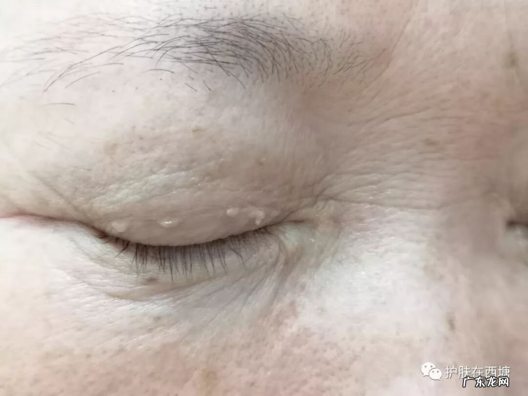 汗管瘤早期图片 汗管瘤图片