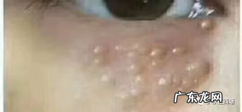 汗管瘤早期图片 汗管瘤图片