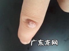 身体上的瘊子怎么去除 怎样去除刺瘊子