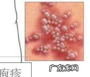 有艾滋病的女人下面有什么症状 性疾病是什么病