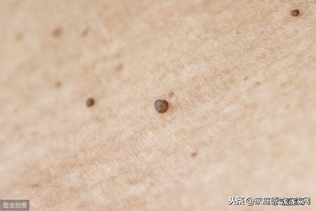 去瘊子最好的药膏 瘊子吃什么药好