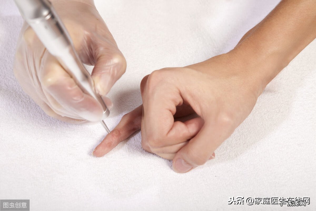 去瘊子最好的药膏 瘊子吃什么药好