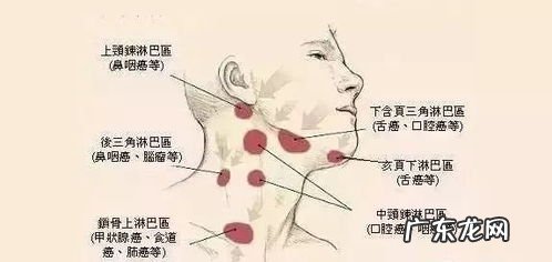 耳后颈部淋巴结肿大挂什么科 颈部淋巴结肿大一般多久自愈正常