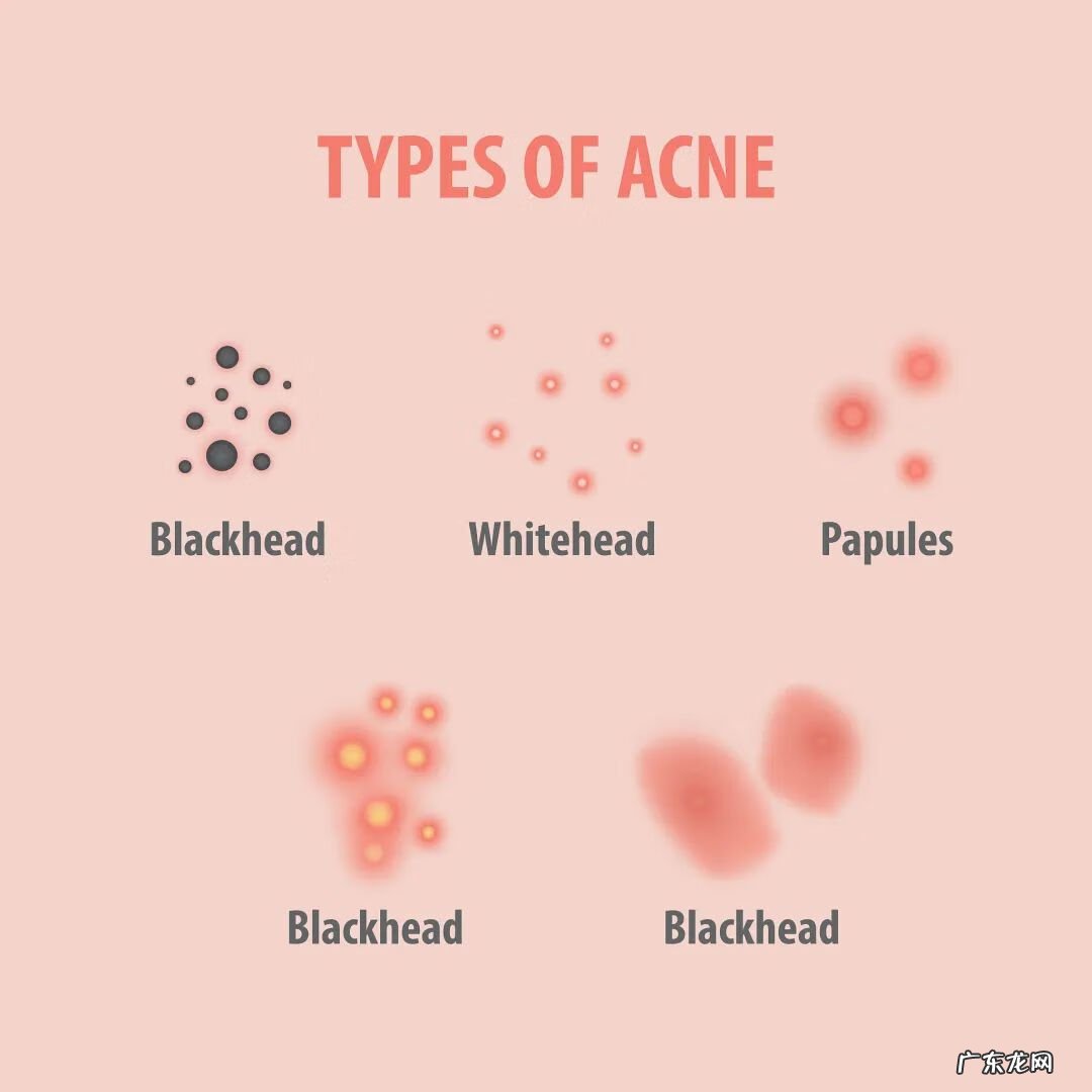 祛痘产品 美容祛痘图片