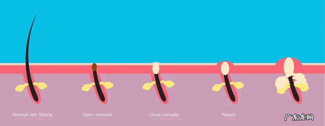 祛痘产品 美容祛痘图片