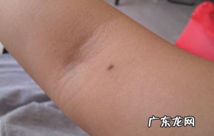左手臂有痣代表什么意思 左手臂有痣代表什么意思男