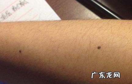 左手臂有痣代表什么意思 左手臂有痣代表什么意思男