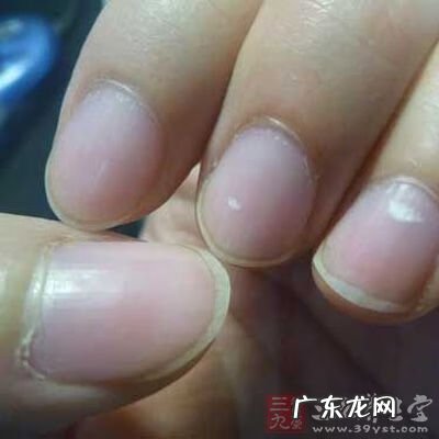 指甲上有白点的原因 指甲上有白点是什么原因