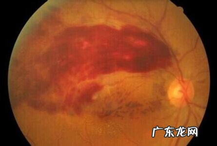 眼底出血是什么原因怎么办 眼底出血怎么办