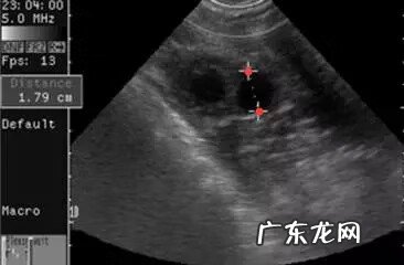 卵泡大小正常范围 正常卵泡大小是多少x多少mm
