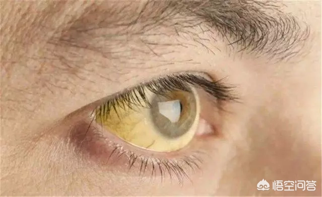 什么食物是肝脏的“保镖”，吃半个月，降酶护肝？