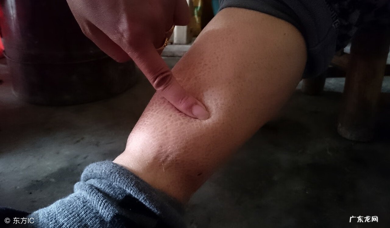 腿肿是什么原因引起的女人怎么办 腿肿的原因有哪些