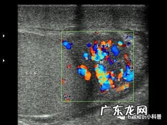 附睾炎是什么引起的呢 什么叫附睾炎