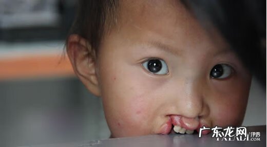 成年后兔唇整容到什么程度 兔唇整形多少钱