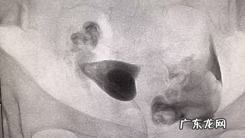 介入疏通输卵管 输卵管介入怎么做的