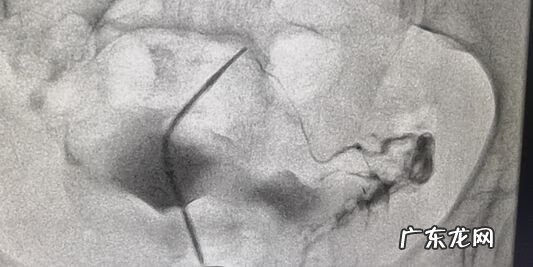 介入疏通输卵管 输卵管介入怎么做的