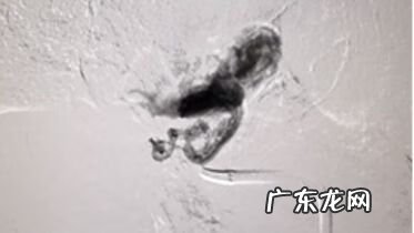 介入疏通输卵管 输卵管介入怎么做的