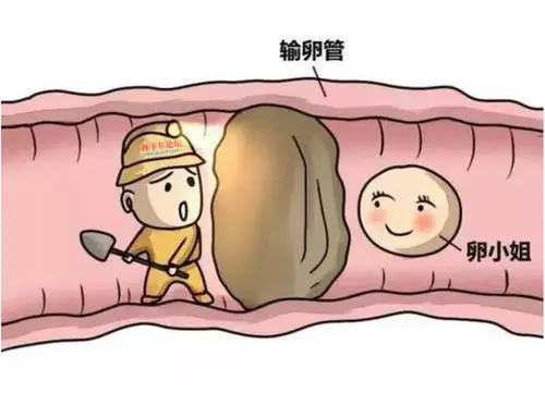 介入疏通输卵管 输卵管介入怎么做的