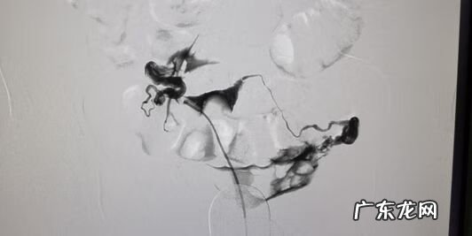 介入疏通输卵管 输卵管介入怎么做的