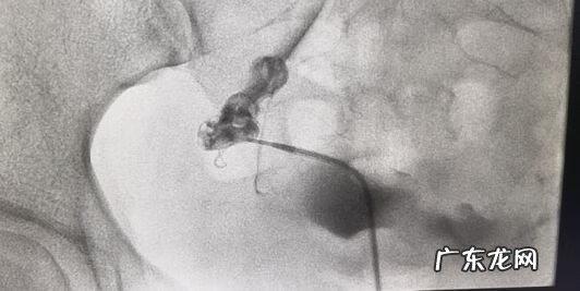 介入疏通输卵管 输卵管介入怎么做的