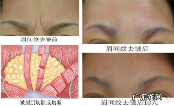 年纪轻轻就有眉间纹该怎么办?