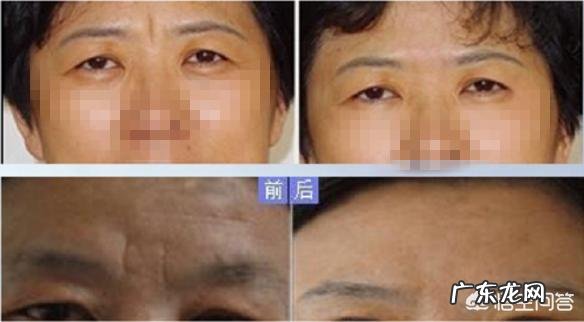 年纪轻轻就有眉间纹该怎么办?