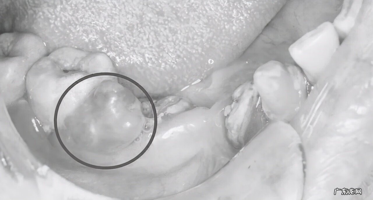 牙龈长了个红色肉疙瘩 牙龈上长了个肉疙瘩是怎么回事