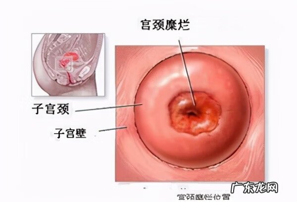 同房后少量出血是怎么了 同房后出血是什么原因造成的