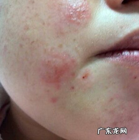 吃什么对皮肤过敏有好处 皮肤过敏吃什么最好的