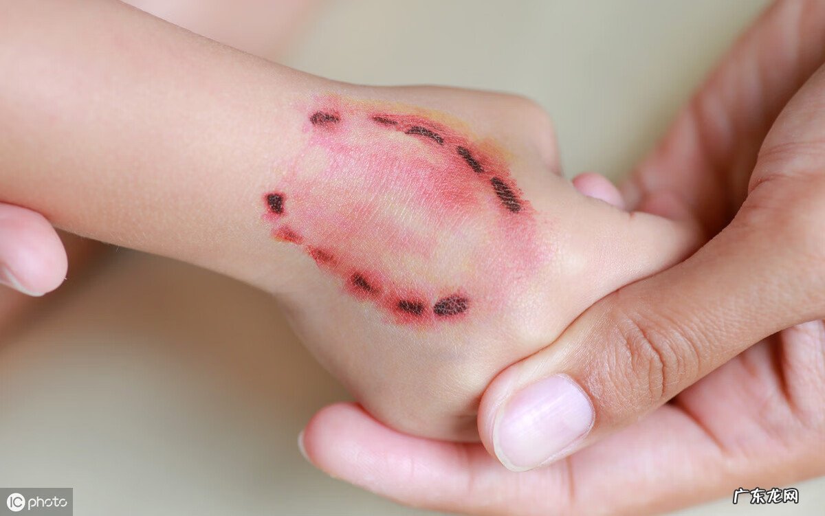 打了狂犬疫苗有效期是多久 人体注射狂犬疫苗有效期是多久