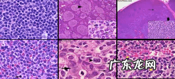 淋巴瘤有哪些分类方式 淋巴瘤分类表
