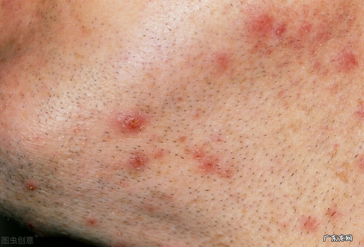 改善鸡皮肤的药 治疗鸡皮肤的药