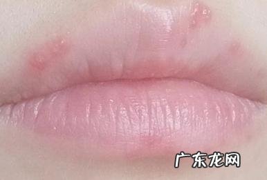疱疹快好了为啥嘴巴还是肿的 嘴唇疱疹过后为什么刺痛肿胀