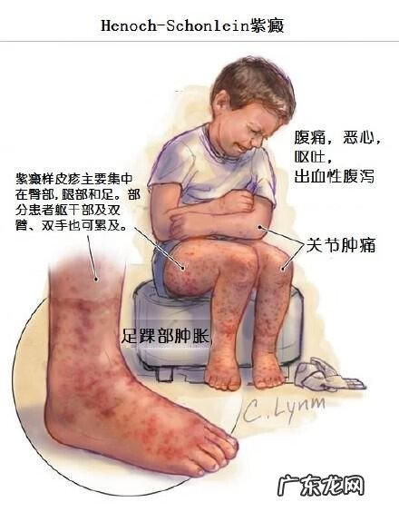儿童过敏性紫癜图片 过敏性紫癜病图片