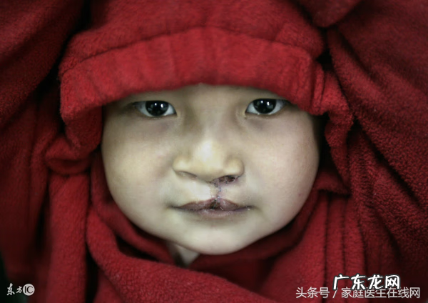 兔唇是否可以免费治疗 兔唇可以治愈吗