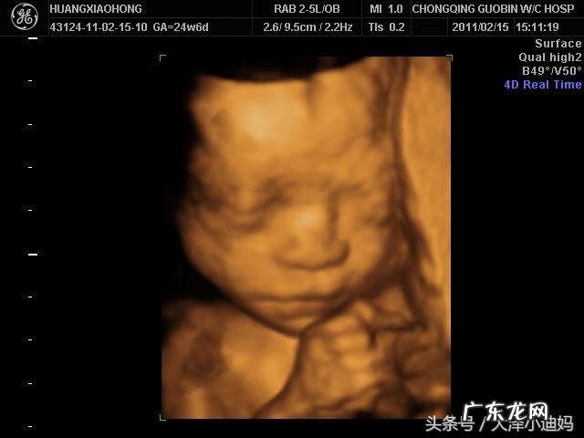 4维B超什么时候做 四维是做b超吗