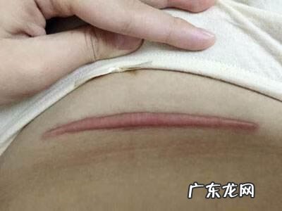 手术疤痕为什么会增生 手术祛疤