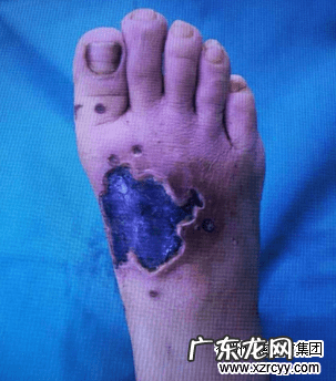 头皮长了刺瘊子 头上长个刺瘊子图片