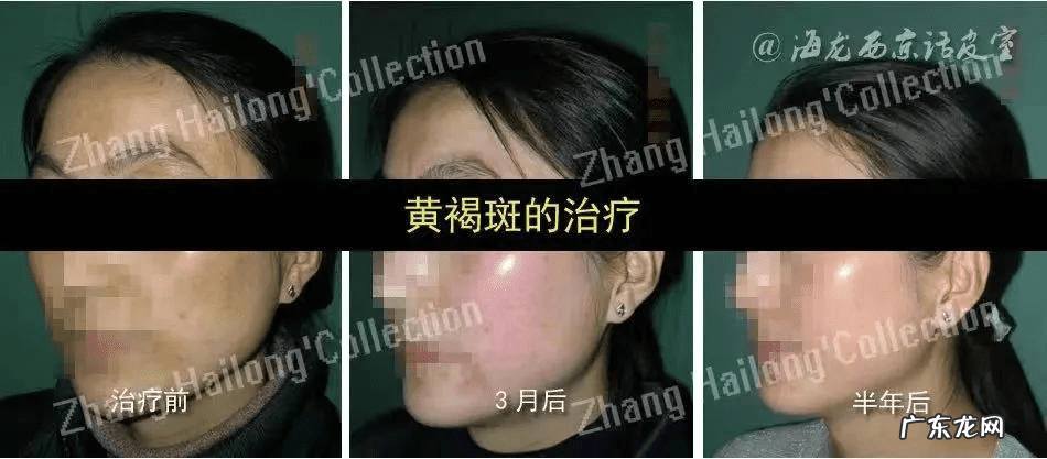得了黄褐斑怎么治疗 黄褐斑是怎么治疗的