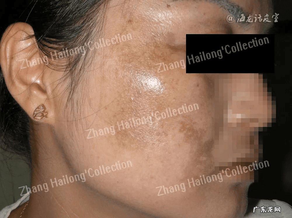 得了黄褐斑怎么治疗 黄褐斑是怎么治疗的