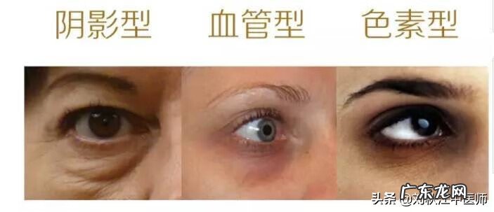 黑眼圈是怎么产生的 黑眼圈的形成原因
